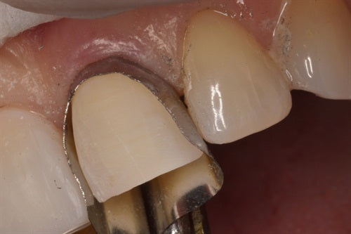 Direct composite veneers #'s 8 & 9