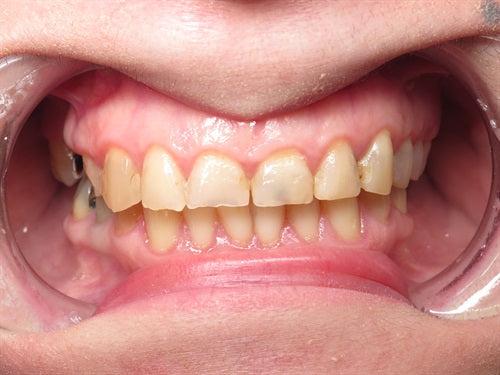 Dahl technique Doc Terry style by Dr. Ahmad Fayad