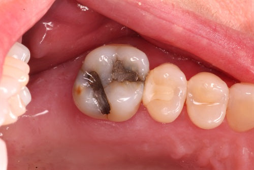 Managing fractured marginal ridge