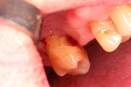 Very deep subgingival decay on the mesial of an isolated molar