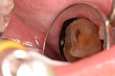 Matrix within a matrix to seal distal margin