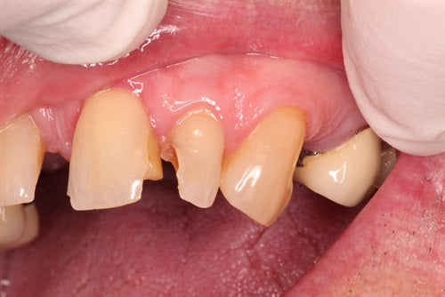 Greater Curve Brass band for Anteriors