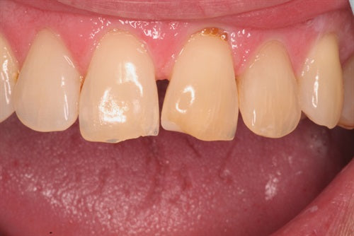 Composite repair for uneven incisal wear