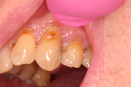 Large composite build up Tooth #11
