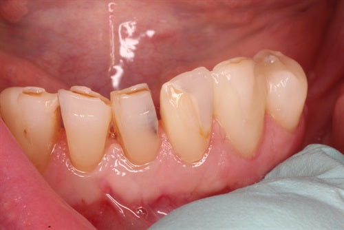 Lower Class IV composites are difficult