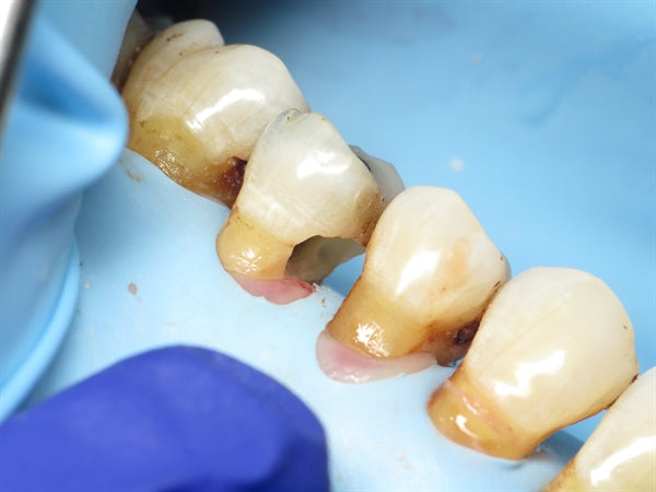 A method to restore root caries