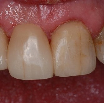 Ribbond splinted bridge with 5 year follow up