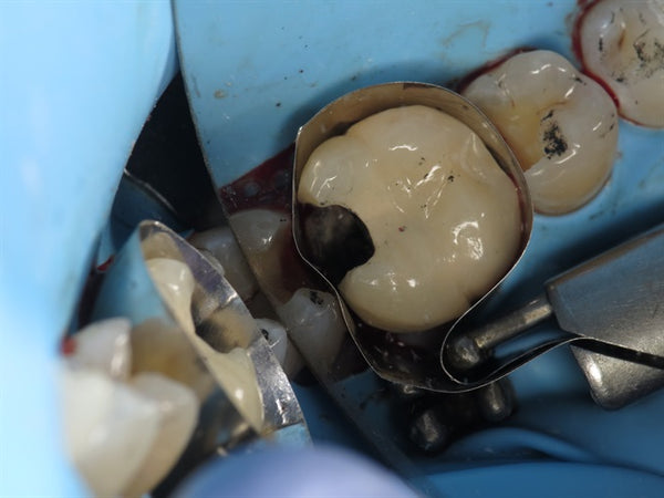 Recurrent caries under crown -