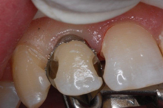 Class III CompositeTechniques