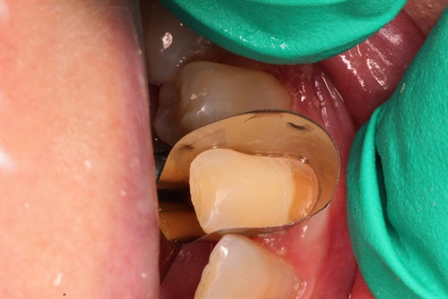 Restoring a Class V lesion and protecting thin friable gingiva from damage