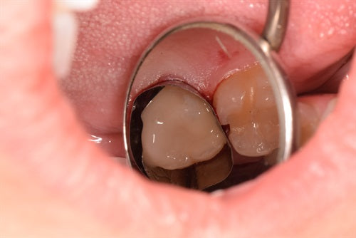 Matrix within a matrix to seal distal margin
