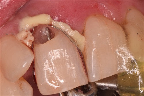 Saving a cental with deep subgingival external root resorption.