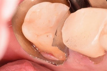 Lingual root Class V caries on #18