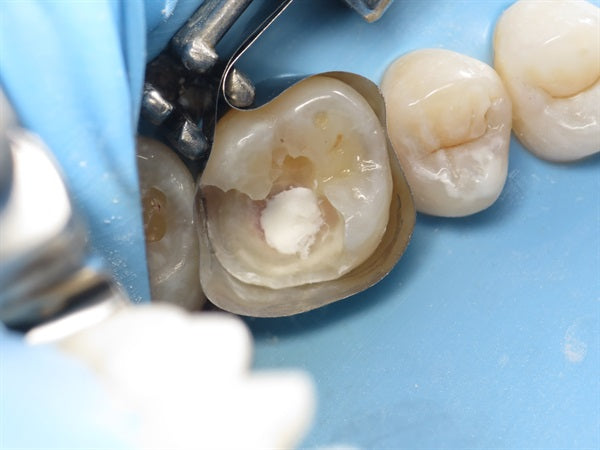 Direct Pulp Cap by Dr. Ahmad Fayad