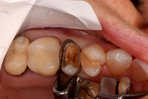 Large composite buildup tooth #13