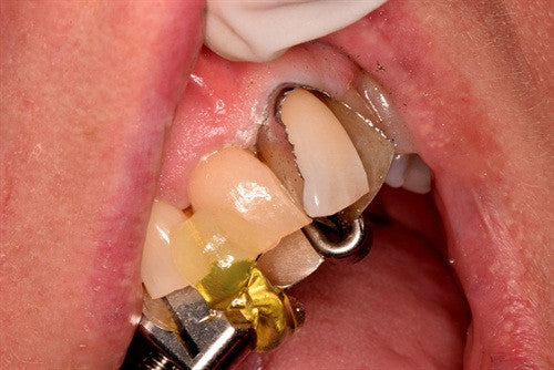 Direct composite veneers on rotated and overlapped teeth