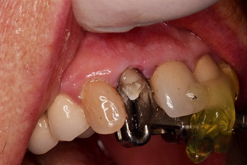 Activa core and composite buildup #7