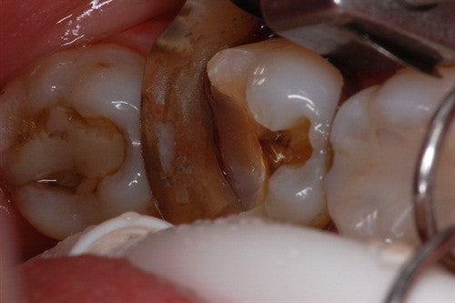 Let's violate biologic width and see what happens