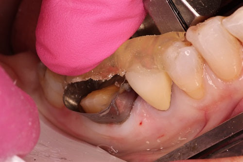 Direct composite onlay made simpler with occlusal stamping.