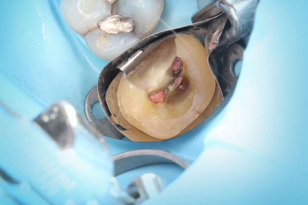 Margin Elevation by Clint K. Taura, DDS