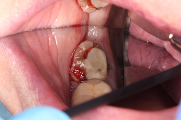 Greater Curve Band and Stamp Technique