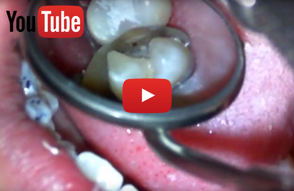 VIDEO: Class II Restoration