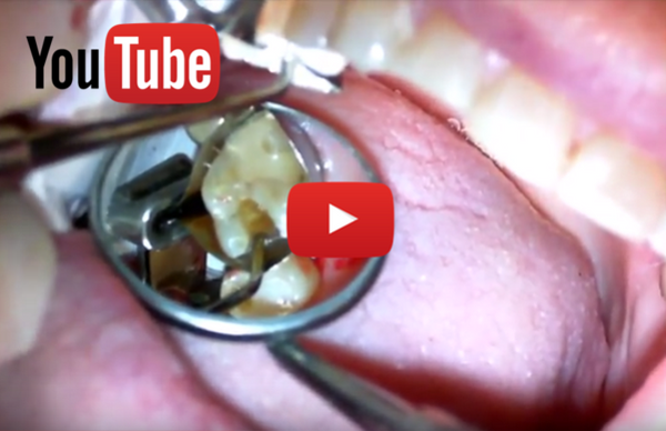 VIDEO: Greater Curve Standard - Class II Restoration