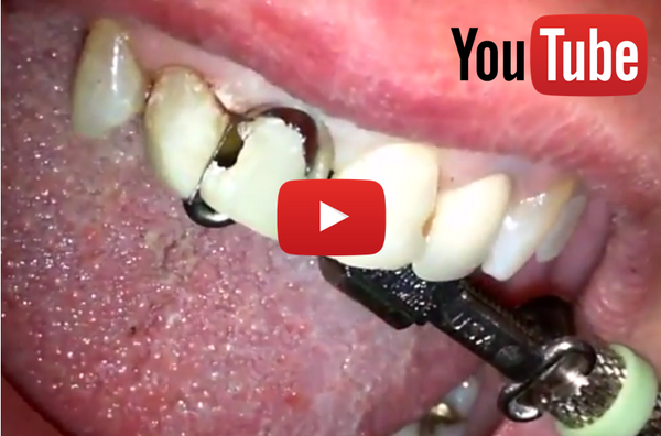 VIDEO: Back to back Class IV's on overlapped teeth