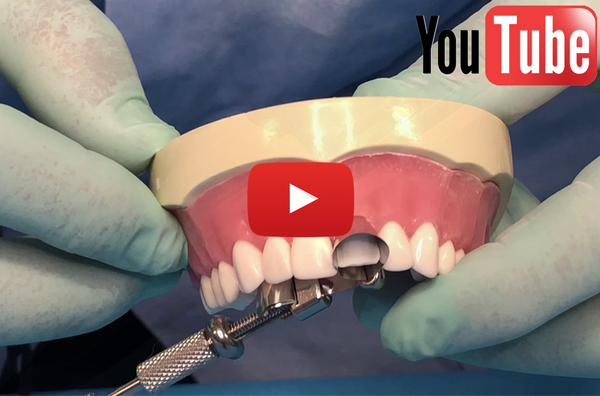 Direct Composite Veneers