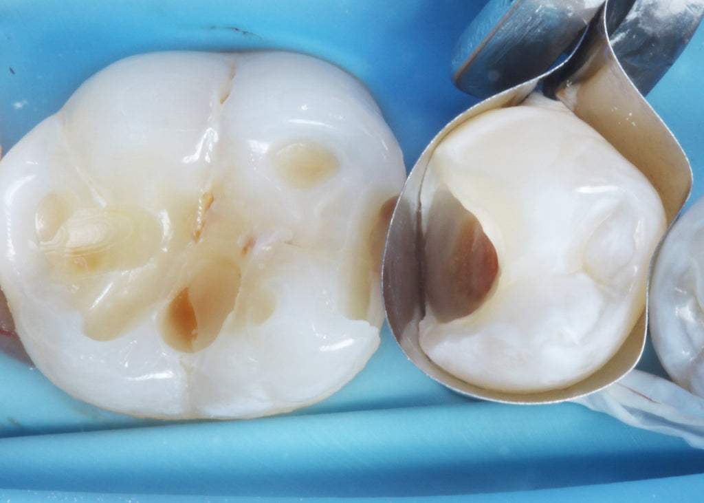 Class II Restoration on Lower Second Premolar – Greater Curve