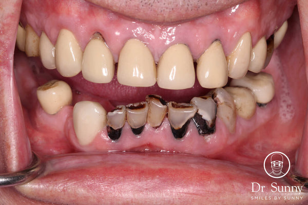 Extremely difficult lower anteriors