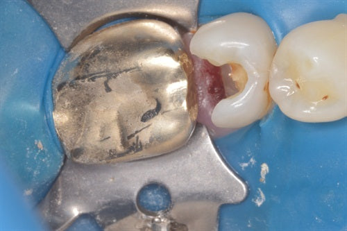 Managing deep root decay and a wide embrasure as an unwanted bonus