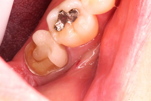 Direct composite crown replacing fractured Lithium Disilicate crown - With 8 month follow up