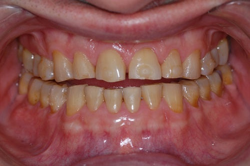 Full upper arch composite rehab 8 years later