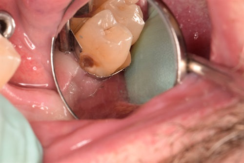 Subgingival distal Class V tooth #29