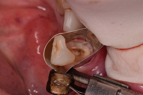 Herodontics for tooth #27