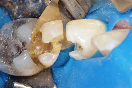 Using Occlusal Stamping with the Greater Curve