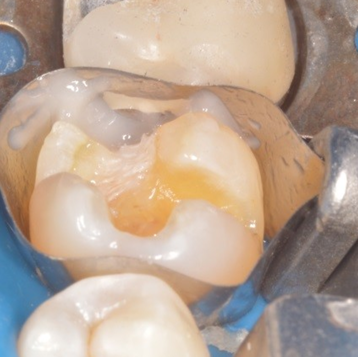 Conservative Treatment of a Fractured Tooth Greater Curve