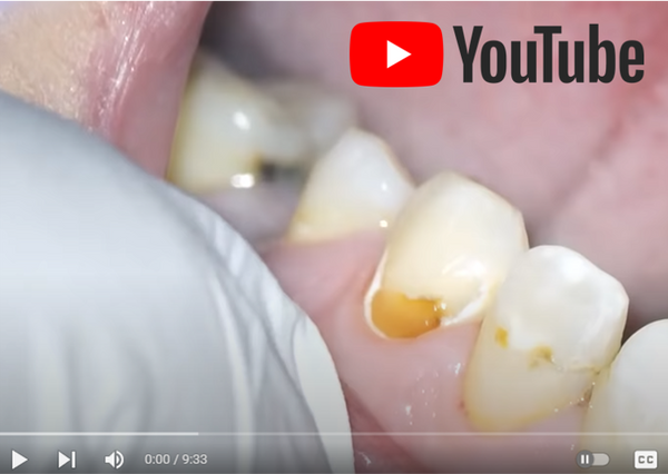 Restoring Difficult Wrap Around Caries - Dr. N. Cory Glenn