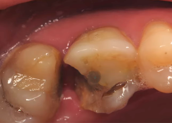Greater Curve Band for monster filling