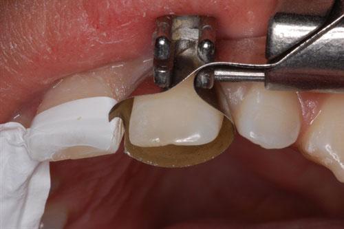 Diastema Closure