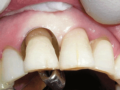 Veneers